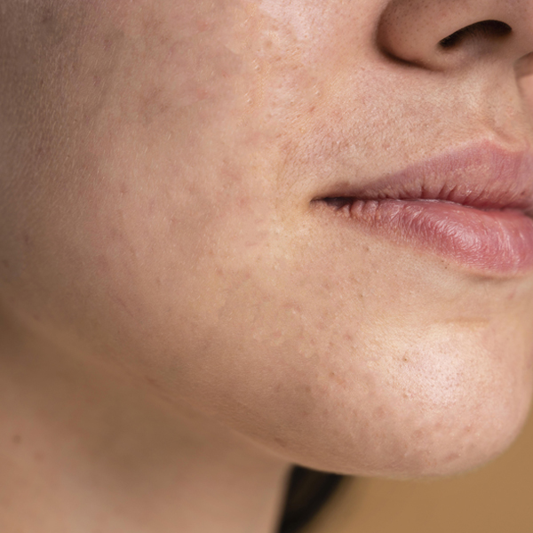 acne (1)